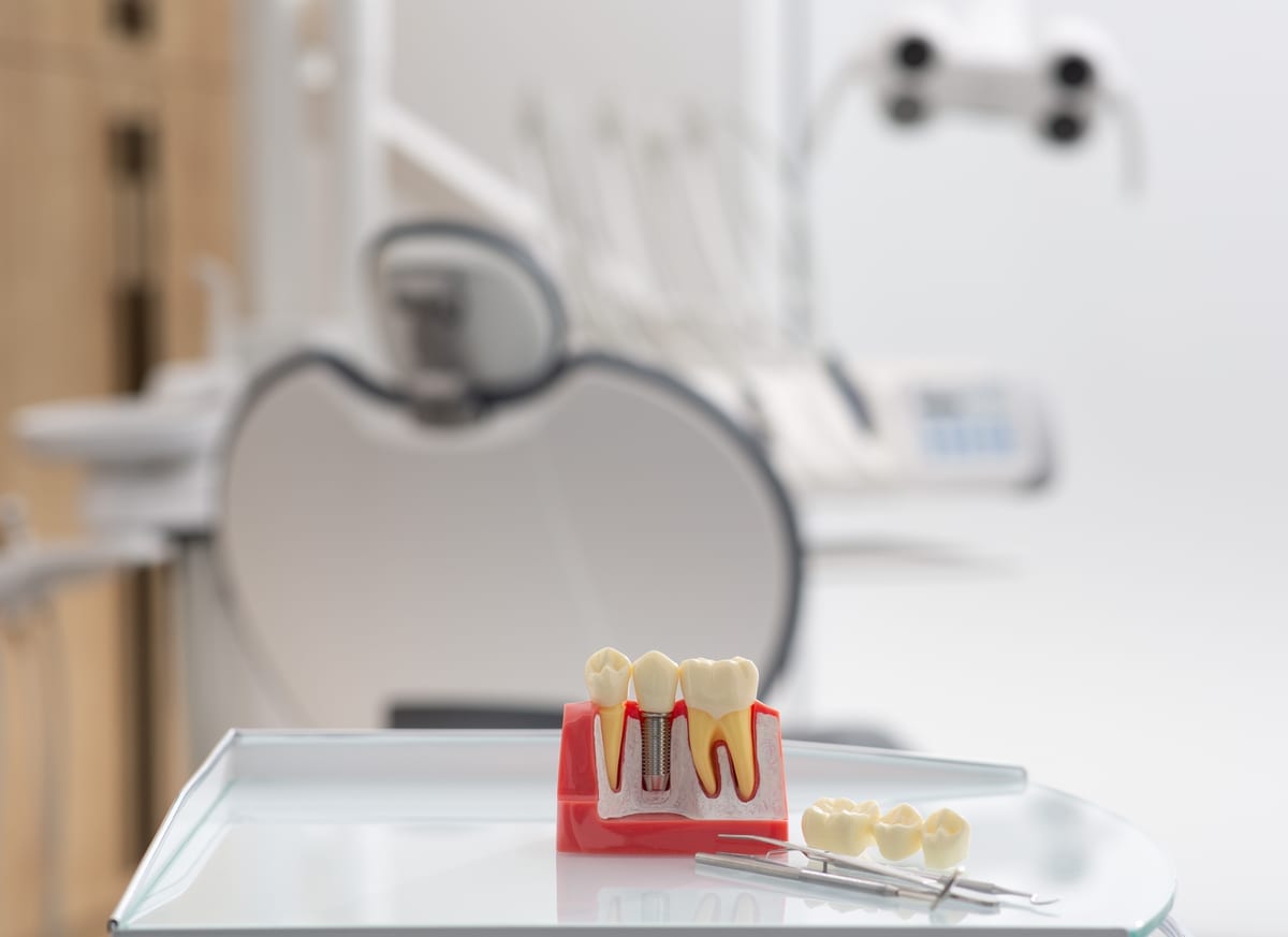 Dental Implants in Ripon